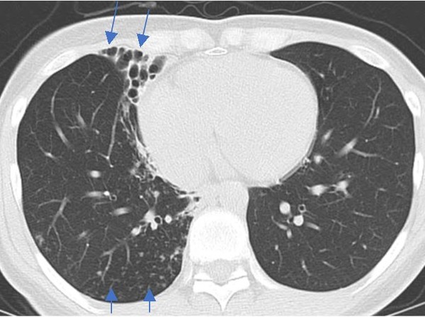 결절성 기관지확장증 형태