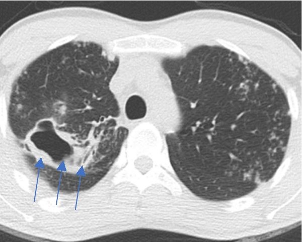 섬유공동성 형태