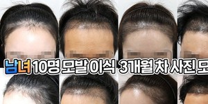 '<b>아는 형님</b>' 이채연, 모발 이식 고백